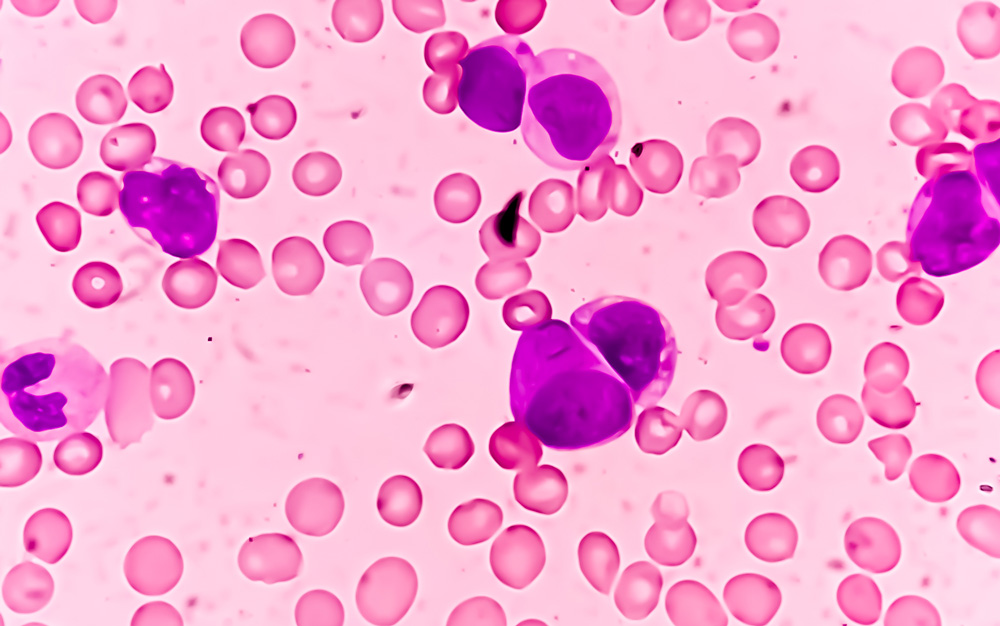 Priothera cleared to begin Japanese arm of pivotal Phase III study with mocravimod in patients with Acute Myeloid Leukemia undergoing allogeneic Hematopoietic Cell Transplant